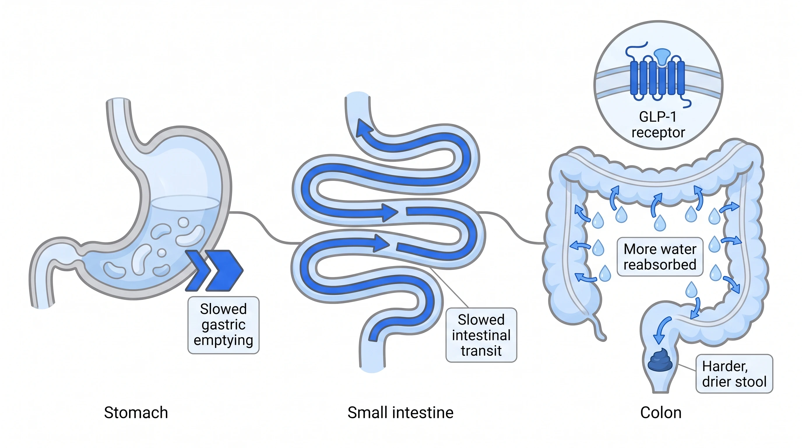 Diagram showing semaglutide slowing gastric emptying and colon transit, leaving harder and drier stool.